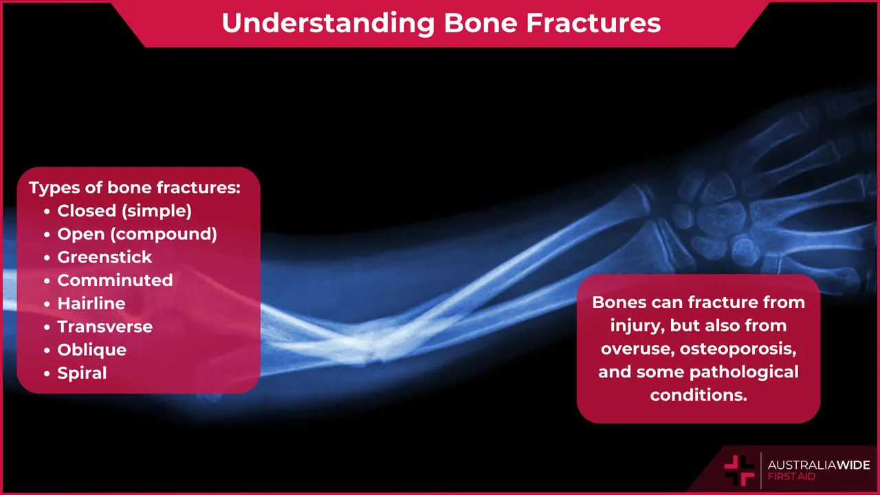 Understanding Bone Fractures article header